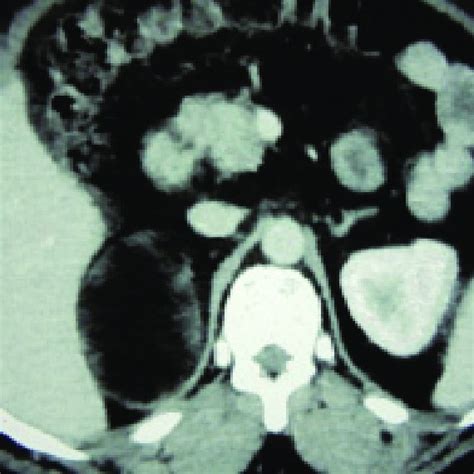 Abdominal Ct Axial Cut Large Right Adrenal Mass With More Or Less