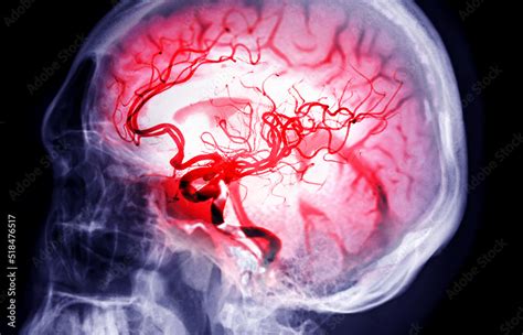 Skull Image Fusion With Mri Mra Brain For Evaluate Them Stenosis And