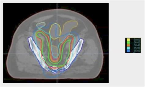 Astro 2024 Dose Escalated Pelvic Lymph Node Imrt With A Simultaneous Hypofractionated Boost To