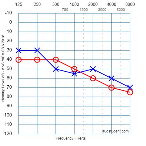 Audiometría ¿qué Es Y Por Qué Es Importante Bienestaraudio