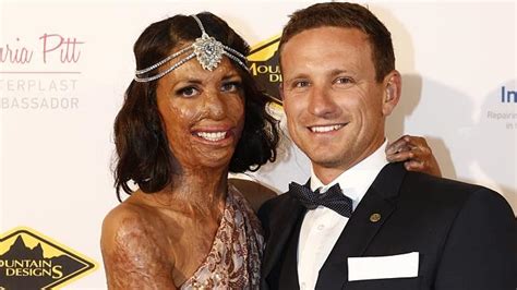 This Ex Model Australian Turia Pitt Suffered Percent Burn Injury