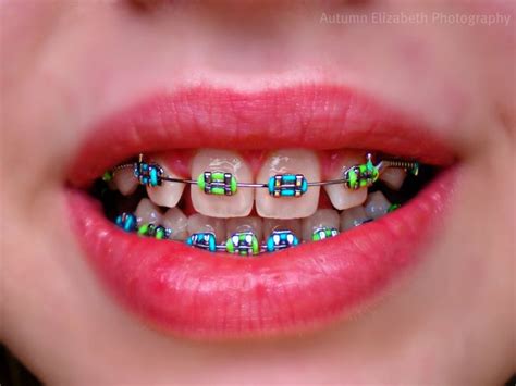 27 mejores imágenes de sonrisas con brackets en Pinterest Ortodoncia