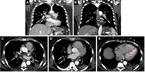 Frontiers Microvascular Angiopathic Consequences Of Covid 19