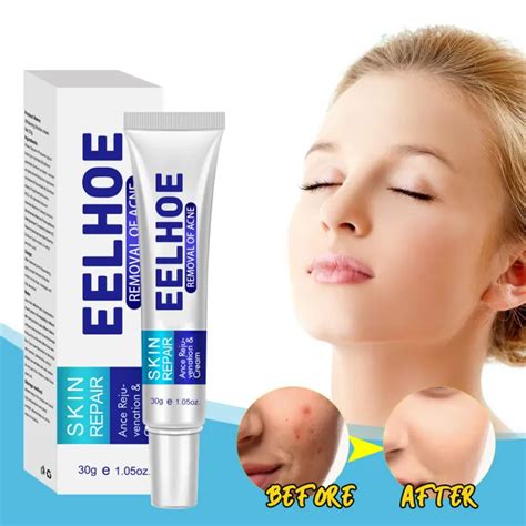 Eelhoe Effective Acne Removal Cream Herbal Anti Acne Treatment Fade Acne Scar Spots Oil Control