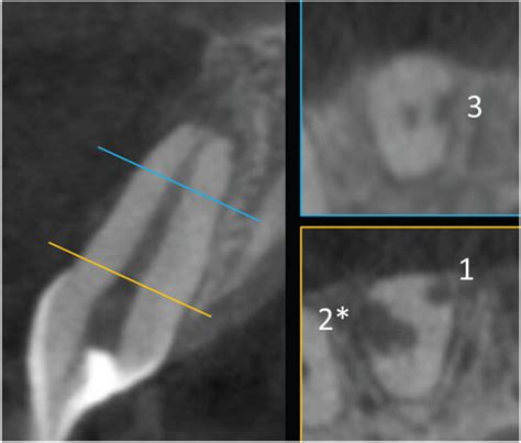 Representative Three Dimensional Images Of External Inflammatory Root