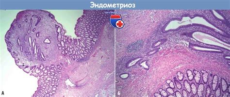 Причины и механизмы развития эндометриоза (аденомиоза)
