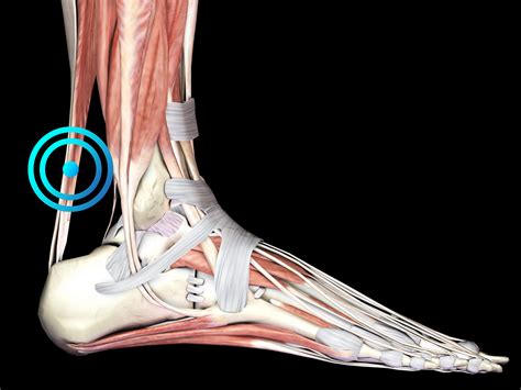 Tendinitis De Aquiles Fisioterapia Sei Herri Sopelana Uribe Kosta