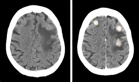 Can a Brain Tumor Cause Eyelid Twitching? » Scary Symptoms