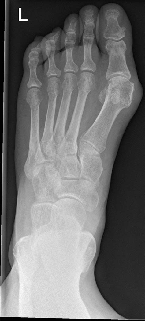 Anterior Calcaneal Process Fracture Image Radiopaedia Org