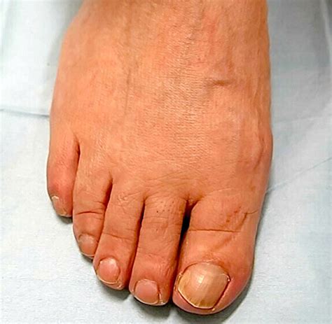 Painful Legs And Moving Toes Syndrome Bmj Case Reports