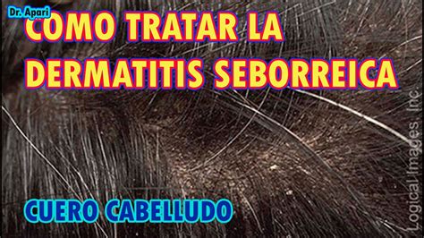 COMO TRATAR LA DERMATITIS SEBORREICA EN CUERO CABELLUDO YouTube