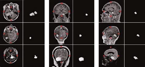 Scielo Brasil Automatic Segmentation Of Brain Tumors In Magnetic