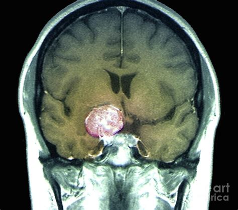 Meningioma Brain Tumour By Zephyr Science Photo Library