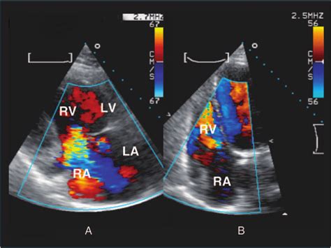 Echocardiographic Doppler Study In Apical Chamber View A Showing