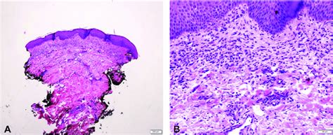 Punch Biopsy Left Abdomen Hande Stain Scanning A And High Power B