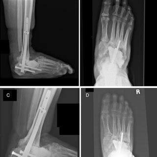 Postoperative Radiographs At A And B Year And C And D