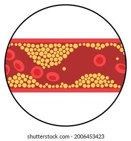 Arteriosclerosis Infarct Ischemia Thrombosis Disease Cholesterol Stock