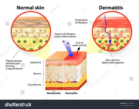 Skin Disease. Dermatitis Or Eczema. Labeled Diagram Stock Vector ...