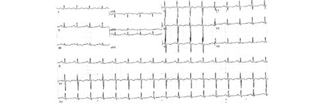 Ecg Of Case Number 1 Shows Regular Sinus Rhythm With Inverted T Waves