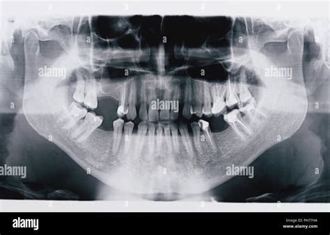 Radiografia Panoramica Immagini E Fotografie Stock Ad Alta Risoluzione