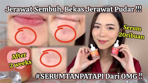 Cobain Serum Terbaru Omg Cuma Ribuan Bebas Jerawat Dan Bekasnya