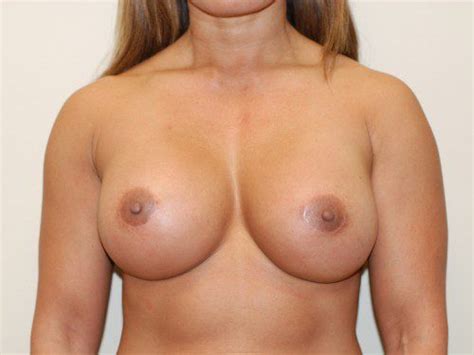 Breast Revision 04 Before After Gallery Allen Doezie MD FACS