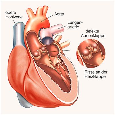 Herzklappenfehler Ursachen Symptome Behandlung Medlexi De