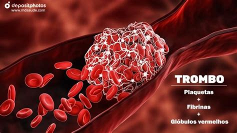 Trombose O Que Causas Sintomas E Locais Comuns