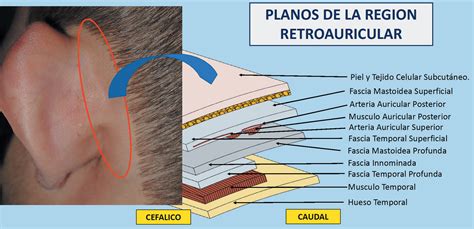 Colgajo Retroauricular Extendido Para La Reconstrucción De Defectos De