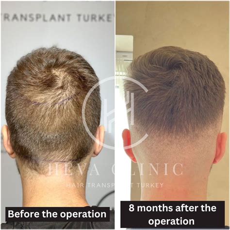 Hair Transplant Donor Area Recovery at Jenna Stokes blog