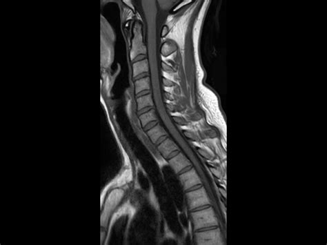 Cervical Spine With Acoustic Noise Reduction Philips Mr Body Map