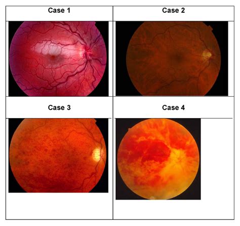 Ischemic Central Retinal Vein Occlusion