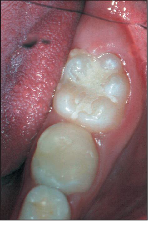 Figure From Effectiveness Of A Glass Ionomer Cement Used As A Pit And