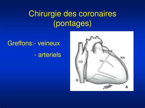 PPT La Chirurgie Cardiovasculaire PowerPoint Presentation Free