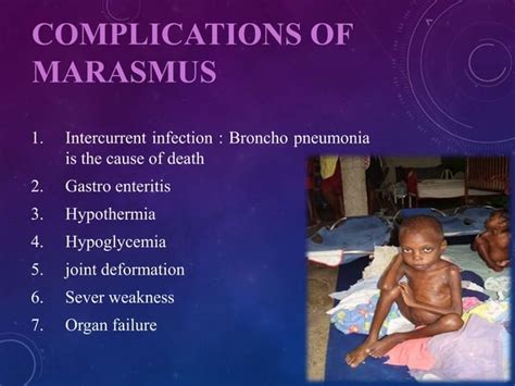 Marasmus A Short Description Ppt