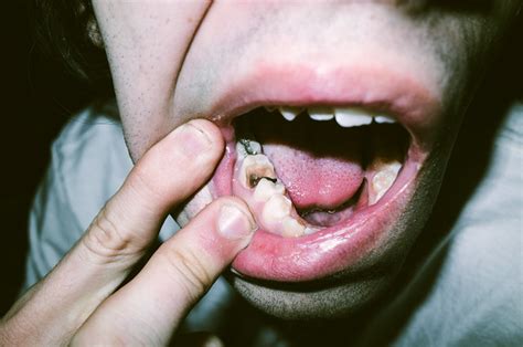 Teeth Close Up | Flickr