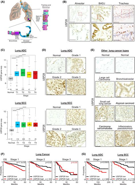 Usp Is Expressed In Human Cell Of Origin For Nsclc And Upregulated