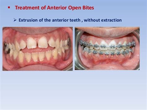 Anterior open bite treatment permanent dentition -1- .slide