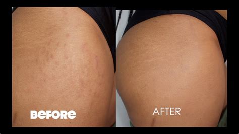 How To Cover Your Stretch Marks For Summer Youtube