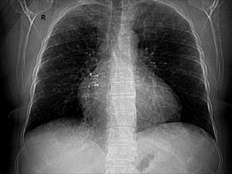 Chest X Ray Shows An Increased Cardiothoracic Ratio And Increased