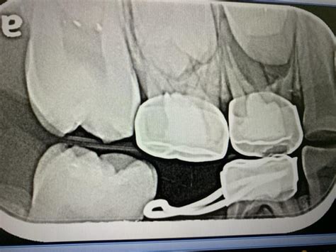 Painful Bump On Hard Palate Rdentistry