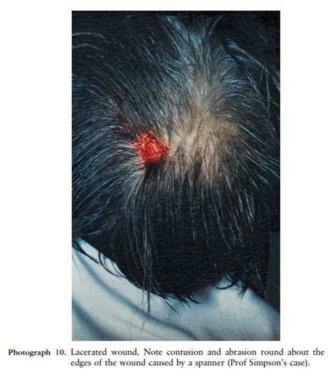 Classification Of Mechanical Trauma