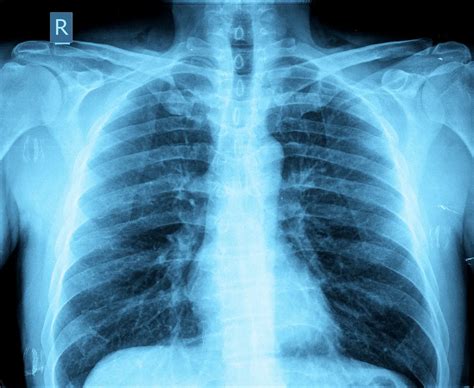 Chest Imaging For Englewood Co Radiology Imaging Associates