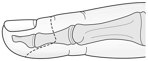 Transmetatarsal Amputation Tma And Toe Amputation Treatments