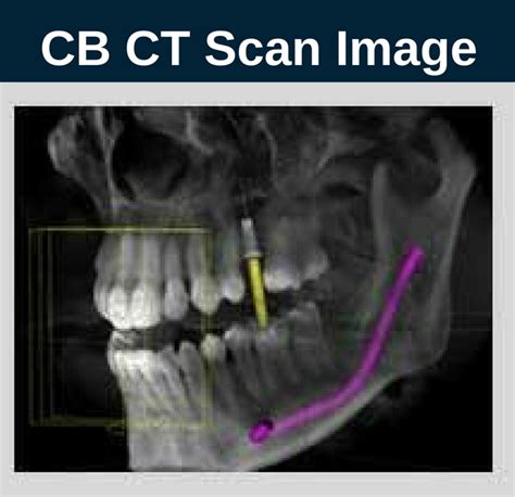 Dental Cone Beam Ct Scan Burbank My Dentist Burbank