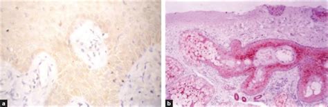 Maspin Immunoreactivity In The Epidermis A And In Sebaceous Glands