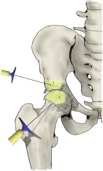 Intraosseous Infiltration Of Platelet Rich Plasma For Severe Hip