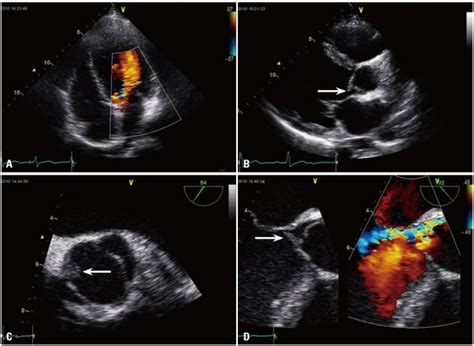 Transthoracic And Transesophageal Echocardiography A Moderate Aortic