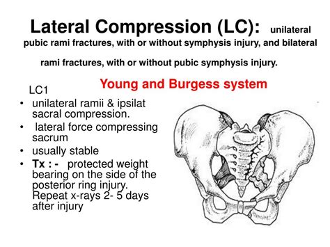 Ppt Pelvis Fracture Powerpoint Presentation Free Download Id737949