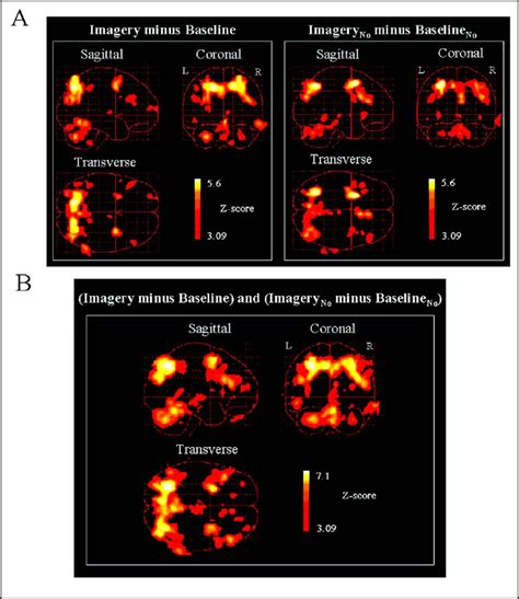 A Statistical Parametric Map Revealing The Areas That Were Activated